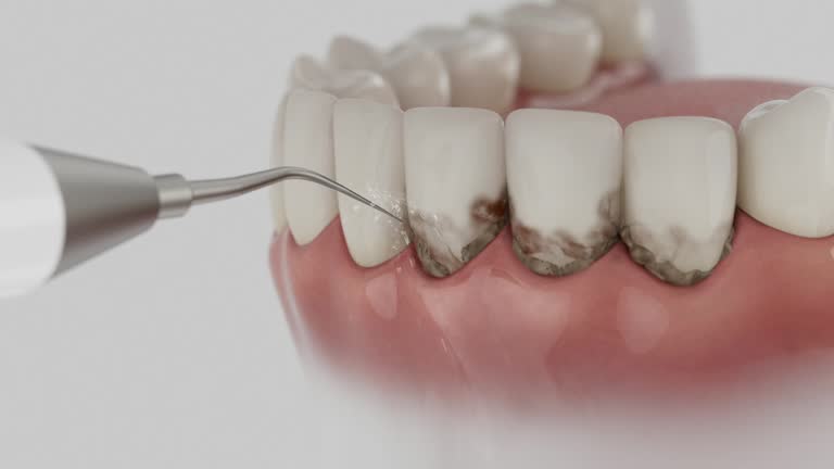 Trusted Wisdom Tooth Removal service in Spencer, IN - Dentist Open Now